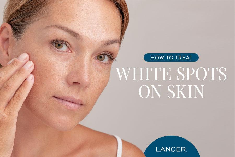 How to Treat White Spots on Skin - Lancer Skincare