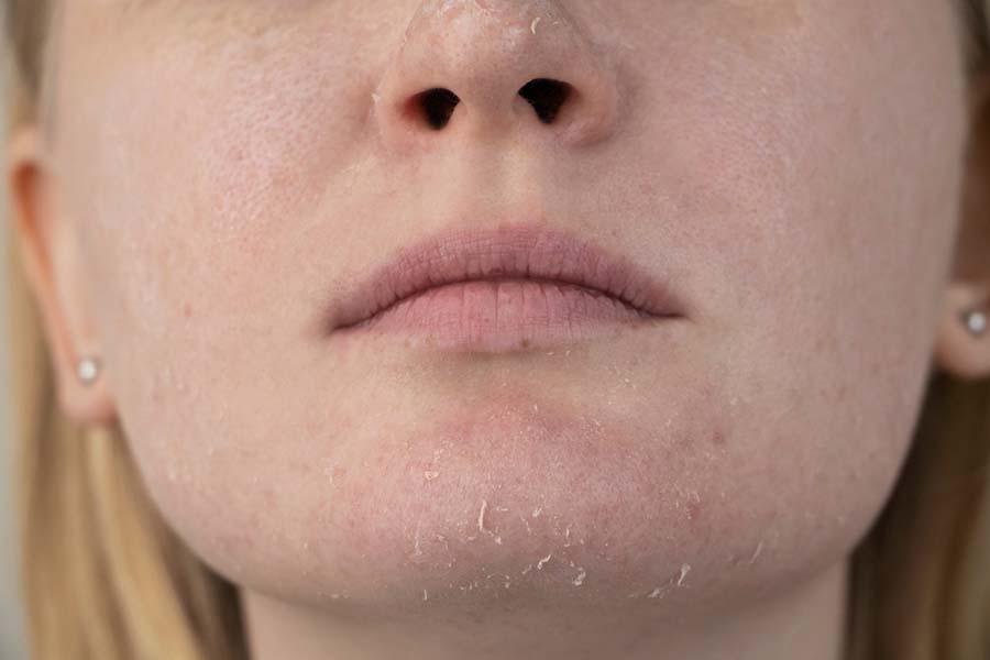 Dry vs. Dehydrated Skin: What You Need to Know - Lancer Skincare