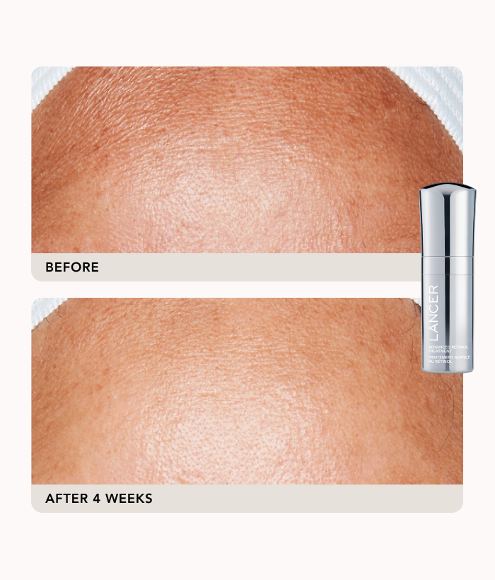 Advanced Treatment Duo-Lancer Skincare
