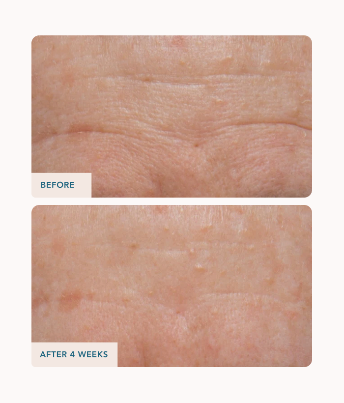 Before and after comparison of skin texture with 'Before' showing more visible wrinkles and 'After 4 Weeks' showing improved texture.-Lancer Skincare