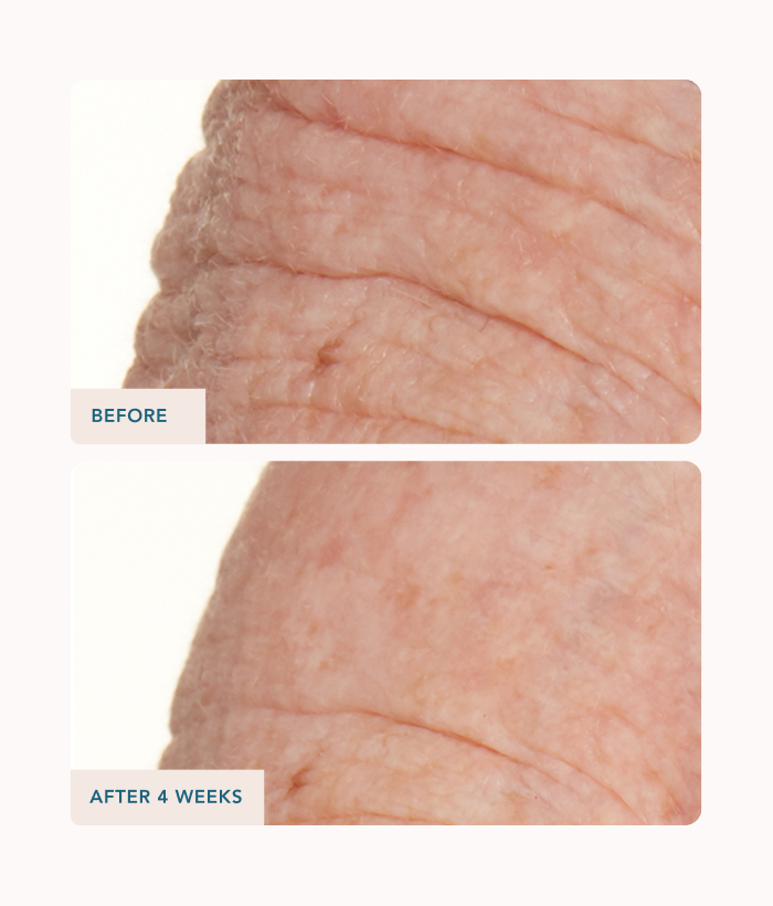 Before and after comparison of skin texture with 'Before' showing more pronounced lines and 'After 4 Weeks' showing improved texture.-Lancer Skincare