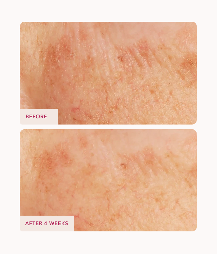 Before and after comparison of skin texture with 'Before' on top and 'After 4 Weeks' on bottom.-Lancer Skincare