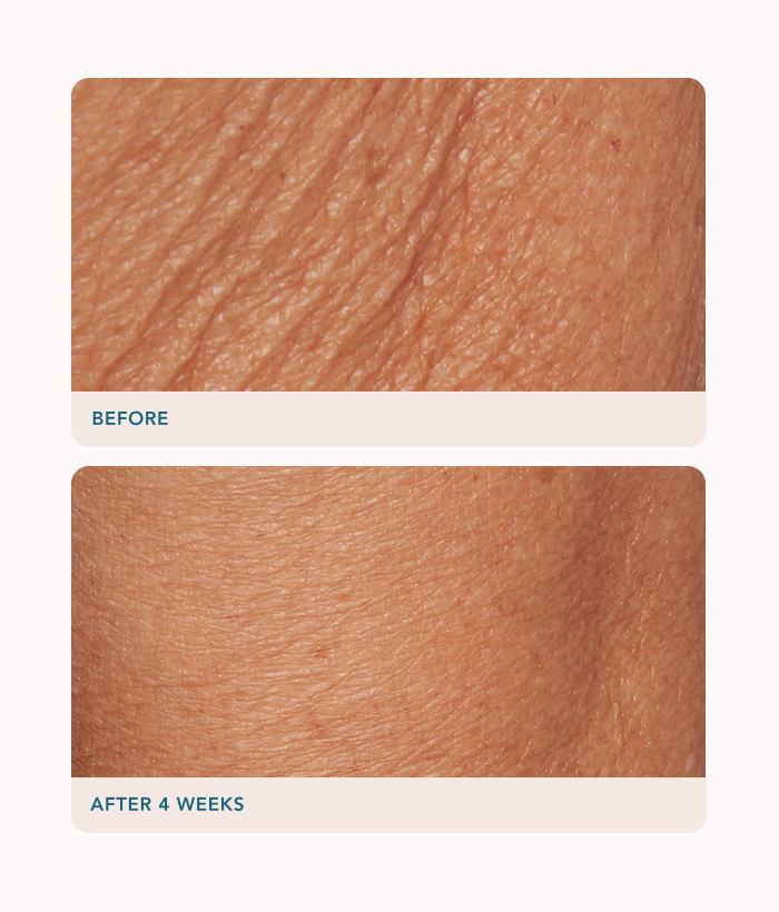 Before and after comparison of skin texture with 'Before' showing rougher texture and 'After 4 Weeks' showing smoother texture.-Lancer Skincare