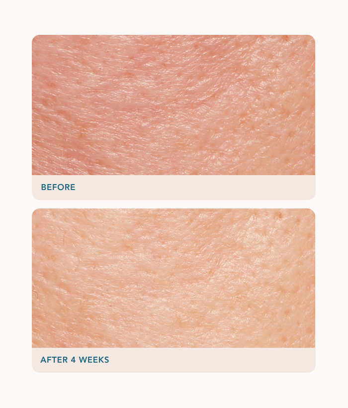 Before and after comparison of skin texture with 'Before' on top and 'After 4 Weeks' on bottom.-Lancer Skincare