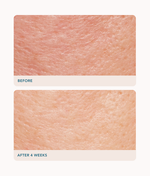 Retexturizing Treatment