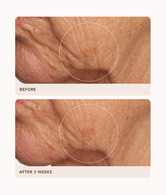 Before and after comparison of skin texture with a focus on wrinkles.-Lancer Skincare