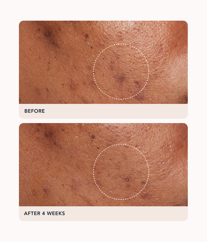 Before and after comparison of skin texture with a circle highlighting a spot on a white background.-Lancer Skincare