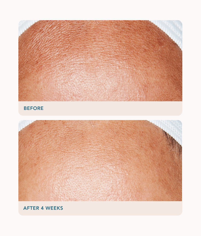Before and after comparison of skin texture on a white background-Lancer Skincare