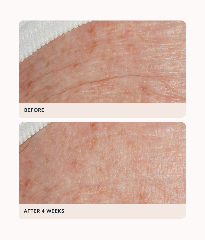 Before and after comparison of skin texture with 'Before' showing rougher skin and 'After 4 Weeks' showing smoother skin.-Lancer Skincare