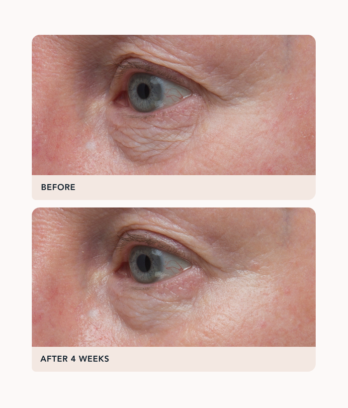 Before and after comparison of eye area treatment showing reduced wrinkles.-Lancer Skincare