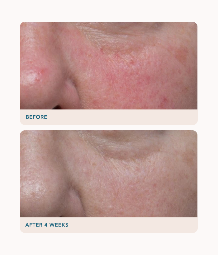 Before and after comparison of skin treatment results on a person's cheek-Lancer Skincare