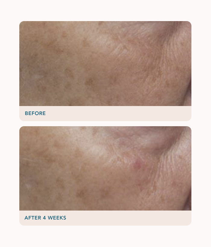 Before and after comparison of skin texture on a white background-Lancer Skincare