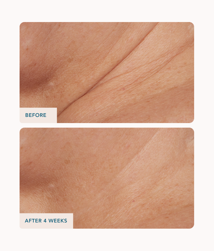 Before and after comparison of skin texture with 'Before' showing rougher texture and 'After 4 Weeks' showing smoother texture.-Lancer Skincare